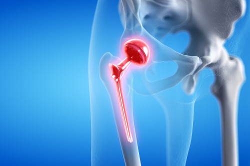 Retour à l’autonomie après une prothèse de hanche grâce à l’aide à domicile