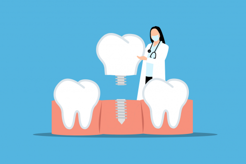 Implant dentaire : remboursement, coût et prise en charge par la mutuelle